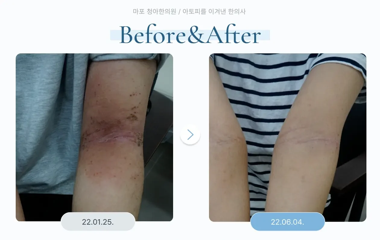 팔 전체 피부 변화 사례