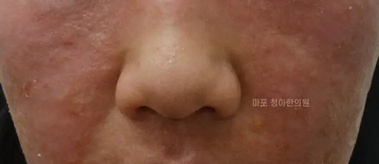 아토피 열감, 냉찜질해도 계속 뜨거운 이유｜3가지 유형을 구분해야 합니다