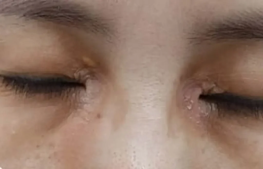 보습제를 발라도 반복되는 눈가 아토피 각질