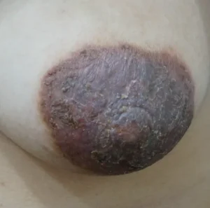 유두와 유륜에 붉은기와 각질이 나타난 피부 상태