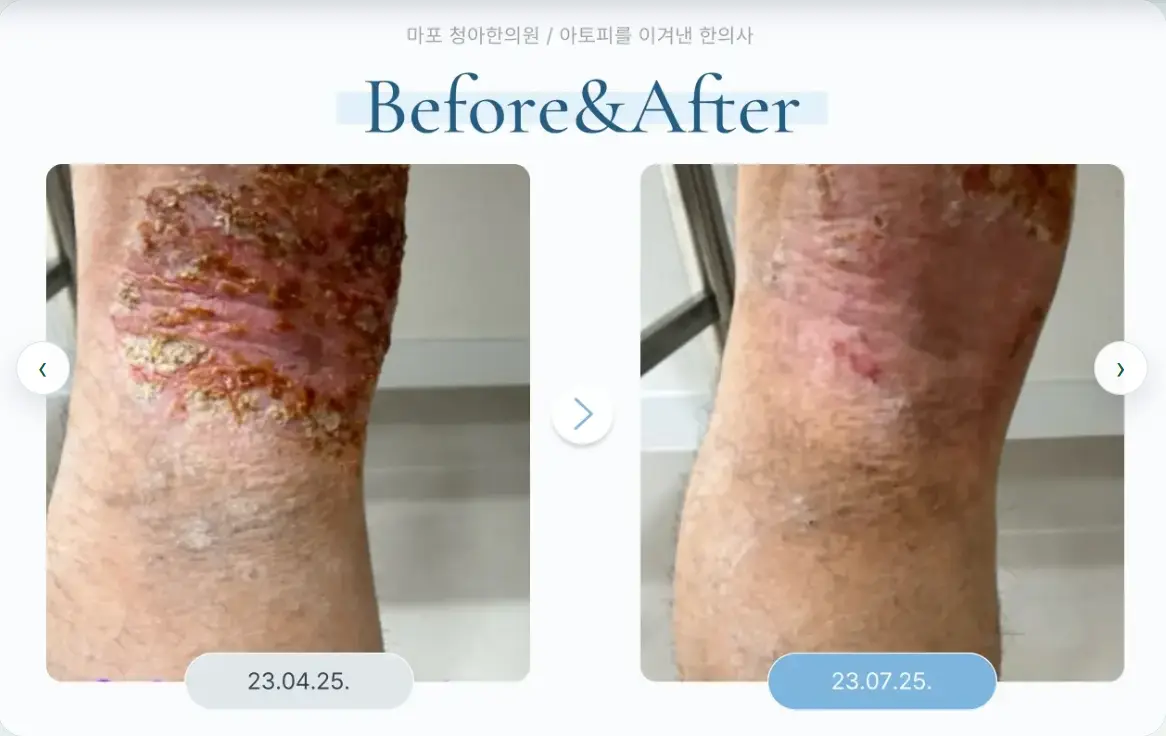 40년간 가려움과 진물이 반복된 아토피 환자의 무릎 뒤 치료 전후 피부 상태