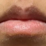 구순염 치료, 스테로이드 중단하면 반복되던 입술 진물·딱지 치료 후 보호 미리보기