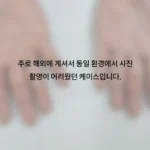 밤마다 가렵고 진물 나던 손습진 치료, 연고를 사용해도 낫지 않았어요 치료 후 보호 미리보기