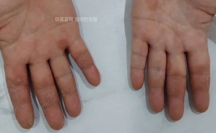 양쪽 손바닥에 건조함과 각질이 나타난 손습진 피부 상태