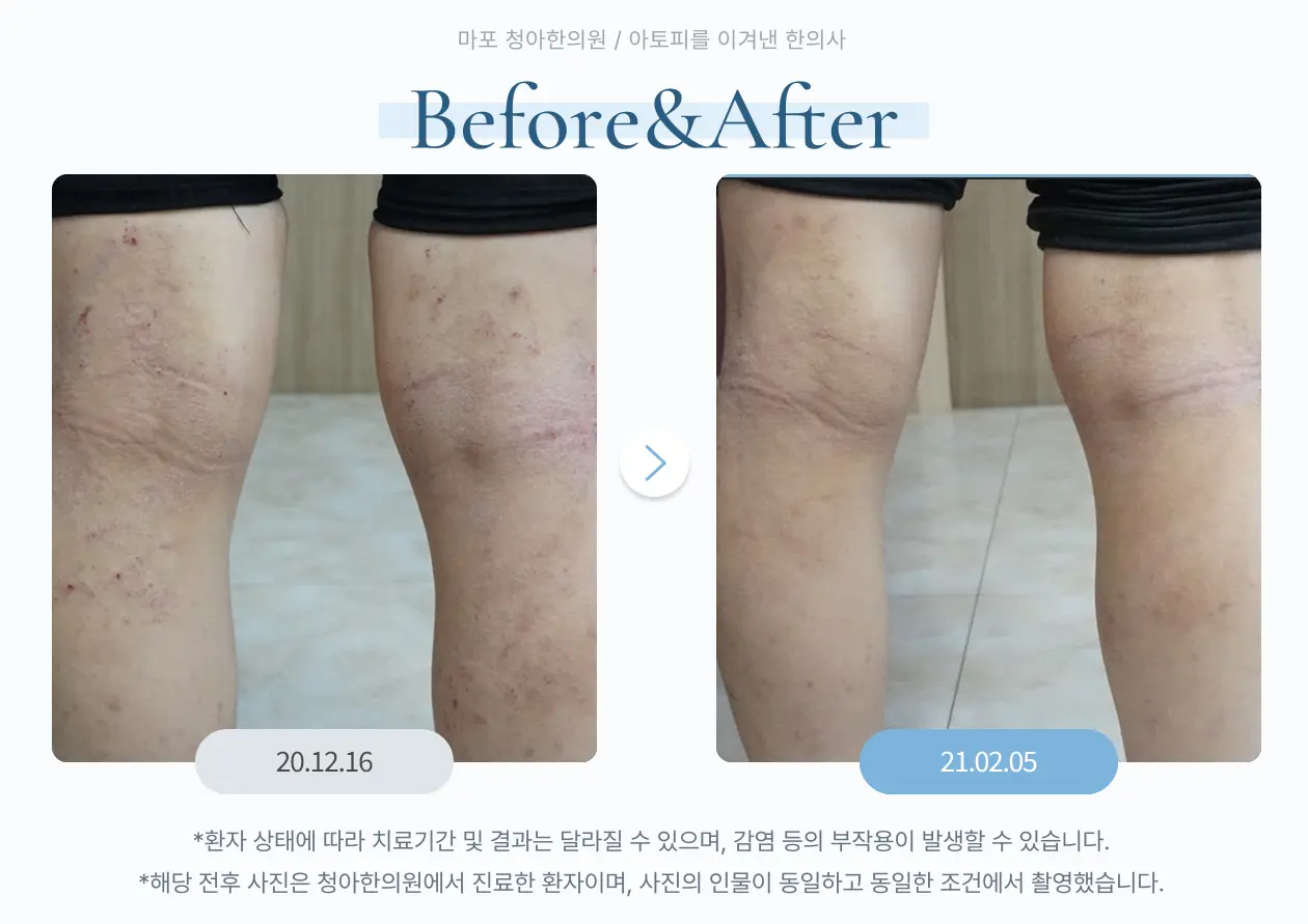 무릎 뒤 피부 변화 치료사례
