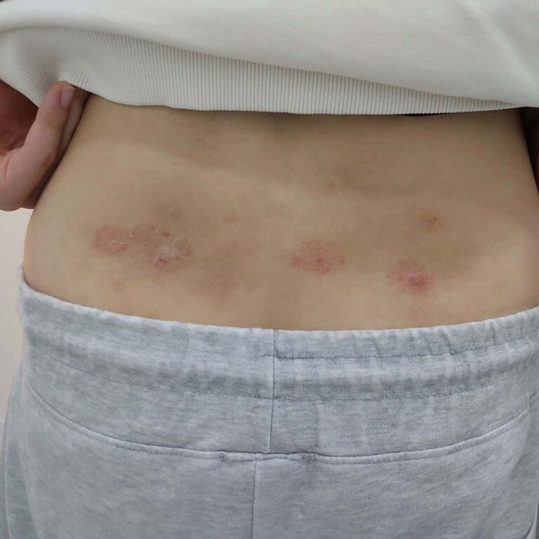 가려워서 편하게 잠을 잔 지가 너무 오래됐어요. 치료 전 사진