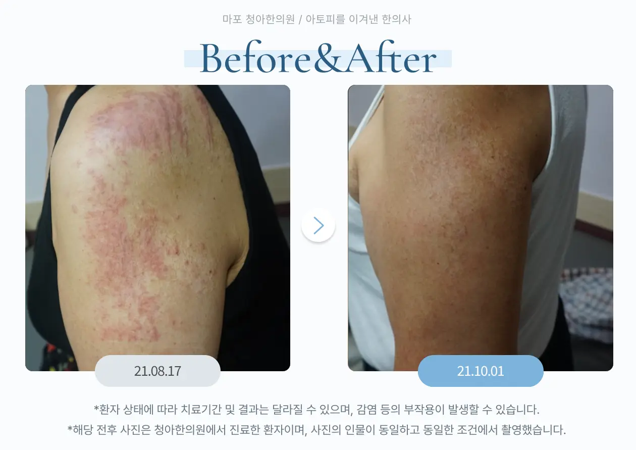 팔 피부 변화 사례
