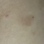 상처만 생기면 습진으로 번졌는데, 이제는 예전처럼 신경 쓰지 않고 생활해도 괜찮아요. 치료 후 보호 미리보기