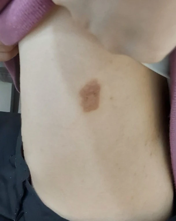 상처만 생기면 습진으로 번졌는데, 이제는 예전처럼 신경 쓰지 않고 생활해도 괜찮아요. 치료 전 사진
